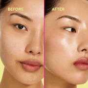 Comparaison avant et après d'un visage de femme avec une amélioration visible de la peau.